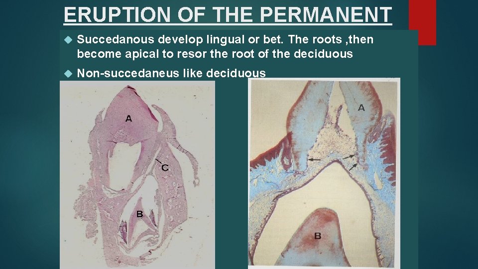 ERUPTION OF THE PERMANENT Succedanous develop lingual or bet. The roots , then become