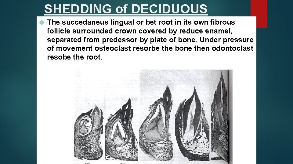 SHEDDING of DECIDUOUS The succedaneus lingual or bet root in its own fibrous follicle