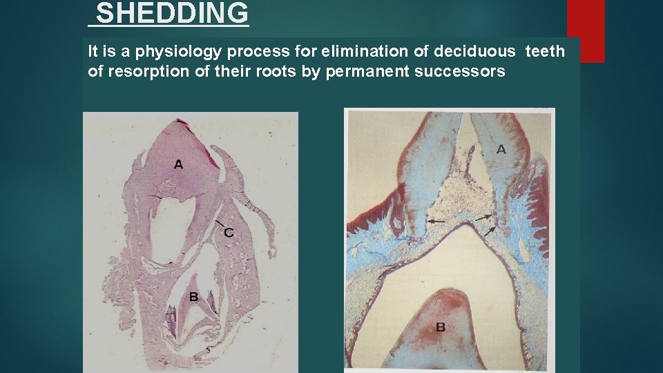 SHEDDING It is a physiology process for elimination of deciduous teeth of resorption of
