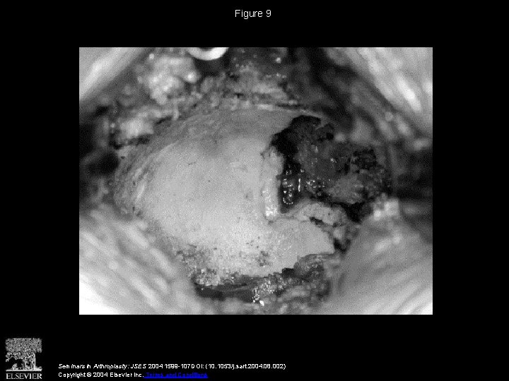 Figure 9 Seminars in Arthroplasty: JSES 2004 1599 -107 DOI: (10. 1053/j. sart. 2004.