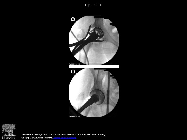 Figure 10 Seminars in Arthroplasty: JSES 2004 1599 -107 DOI: (10. 1053/j. sart. 2004.