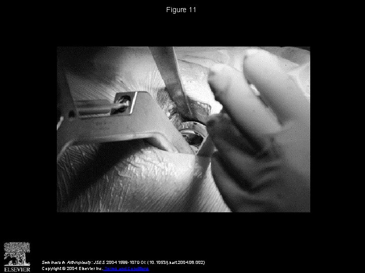 Figure 11 Seminars in Arthroplasty: JSES 2004 1599 -107 DOI: (10. 1053/j. sart. 2004.