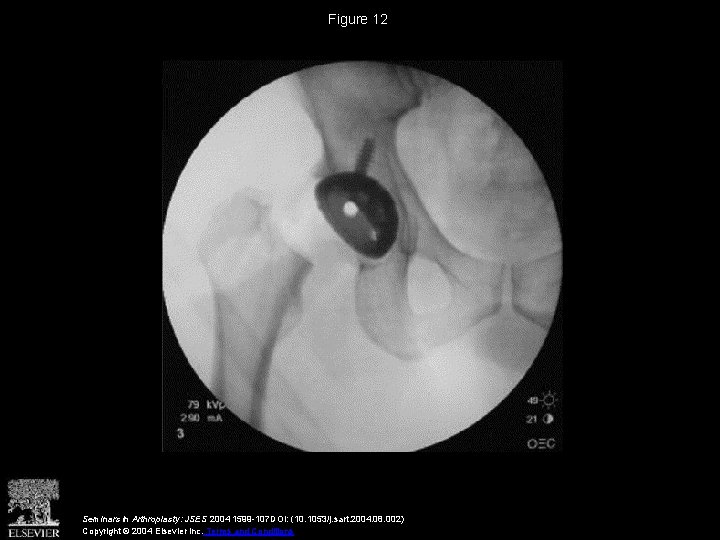 Figure 12 Seminars in Arthroplasty: JSES 2004 1599 -107 DOI: (10. 1053/j. sart. 2004.