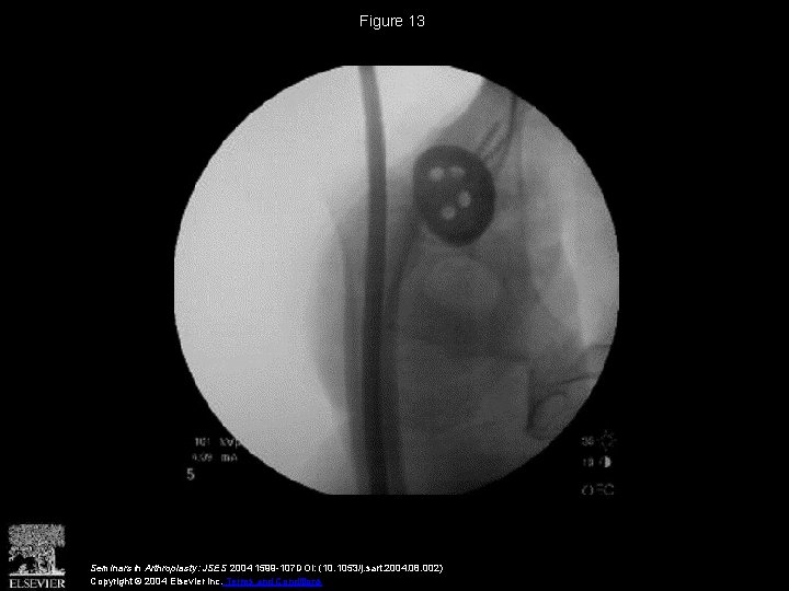 Figure 13 Seminars in Arthroplasty: JSES 2004 1599 -107 DOI: (10. 1053/j. sart. 2004.