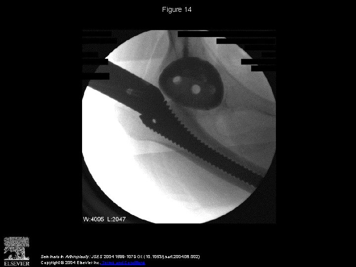 Figure 14 Seminars in Arthroplasty: JSES 2004 1599 -107 DOI: (10. 1053/j. sart. 2004.