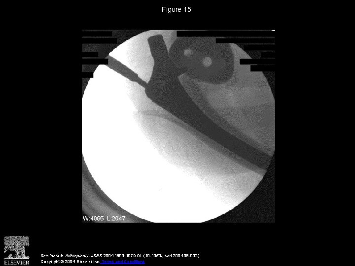 Figure 15 Seminars in Arthroplasty: JSES 2004 1599 -107 DOI: (10. 1053/j. sart. 2004.