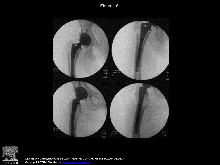 Figure 16 Seminars in Arthroplasty: JSES 2004 1599 -107 DOI: (10. 1053/j. sart. 2004.