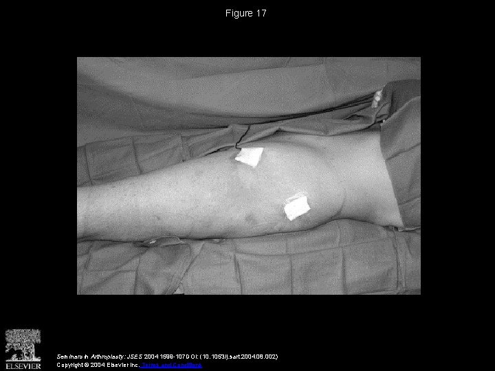 Figure 17 Seminars in Arthroplasty: JSES 2004 1599 -107 DOI: (10. 1053/j. sart. 2004.