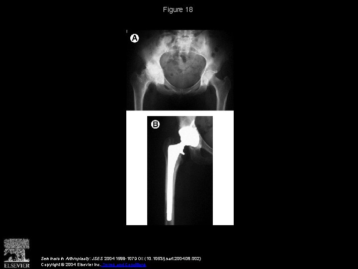 Figure 18 Seminars in Arthroplasty: JSES 2004 1599 -107 DOI: (10. 1053/j. sart. 2004.