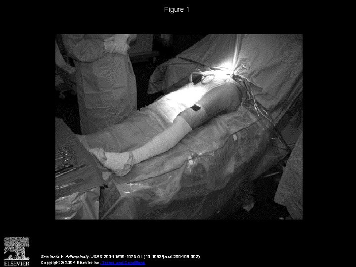 Figure 1 Seminars in Arthroplasty: JSES 2004 1599 -107 DOI: (10. 1053/j. sart. 2004.