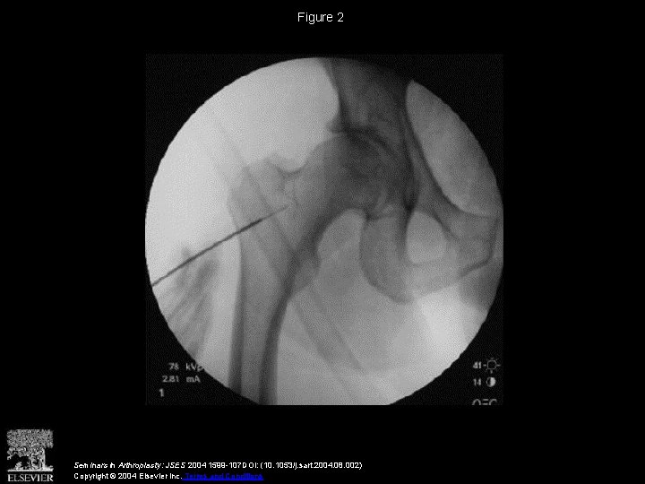 Figure 2 Seminars in Arthroplasty: JSES 2004 1599 -107 DOI: (10. 1053/j. sart. 2004.