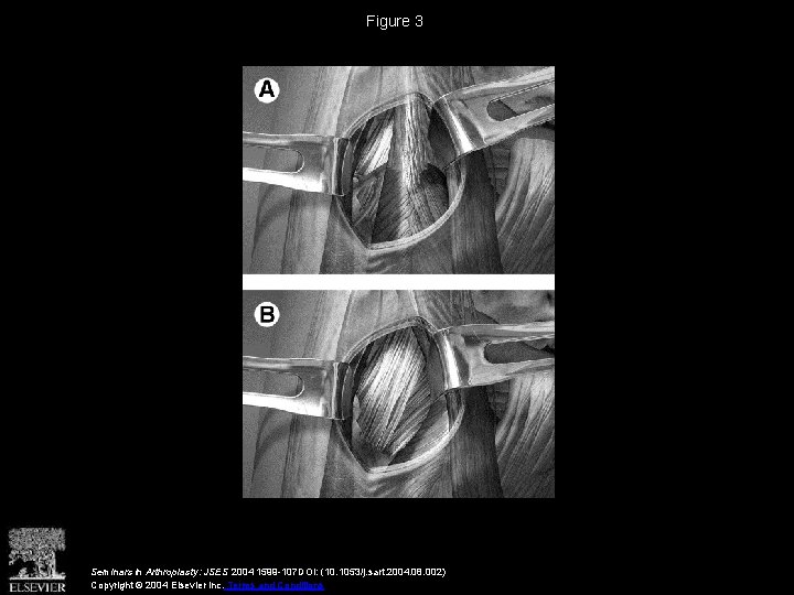 Figure 3 Seminars in Arthroplasty: JSES 2004 1599 -107 DOI: (10. 1053/j. sart. 2004.
