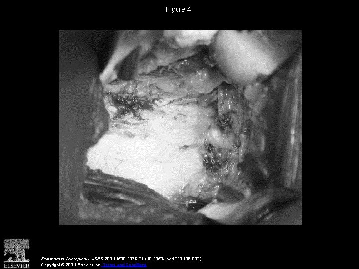 Figure 4 Seminars in Arthroplasty: JSES 2004 1599 -107 DOI: (10. 1053/j. sart. 2004.