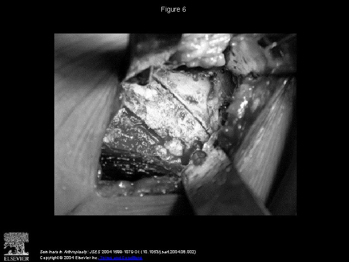 Figure 6 Seminars in Arthroplasty: JSES 2004 1599 -107 DOI: (10. 1053/j. sart. 2004.