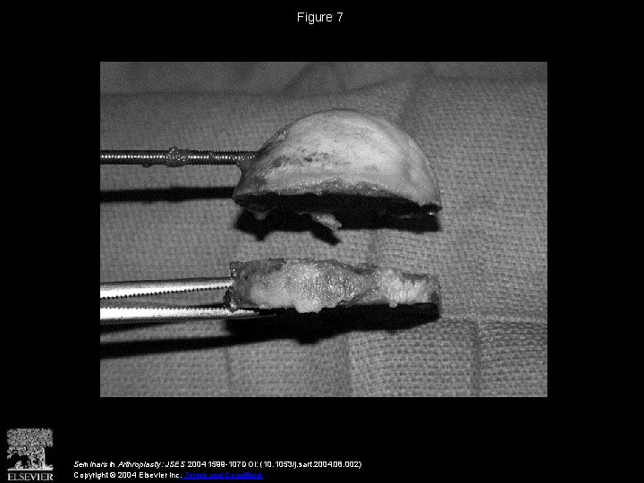 Figure 7 Seminars in Arthroplasty: JSES 2004 1599 -107 DOI: (10. 1053/j. sart. 2004.