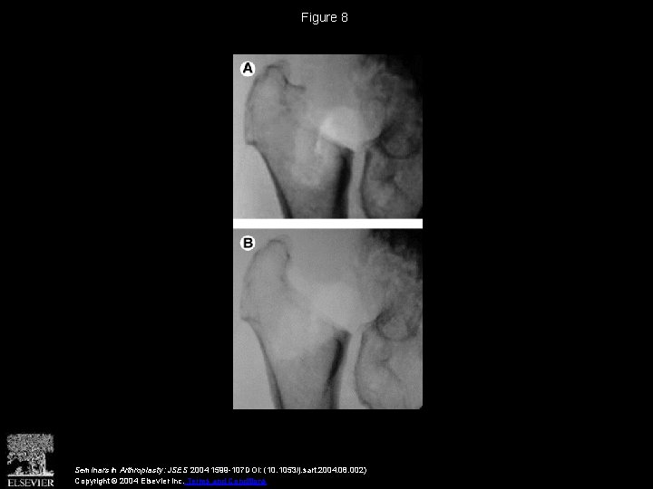 Figure 8 Seminars in Arthroplasty: JSES 2004 1599 -107 DOI: (10. 1053/j. sart. 2004.