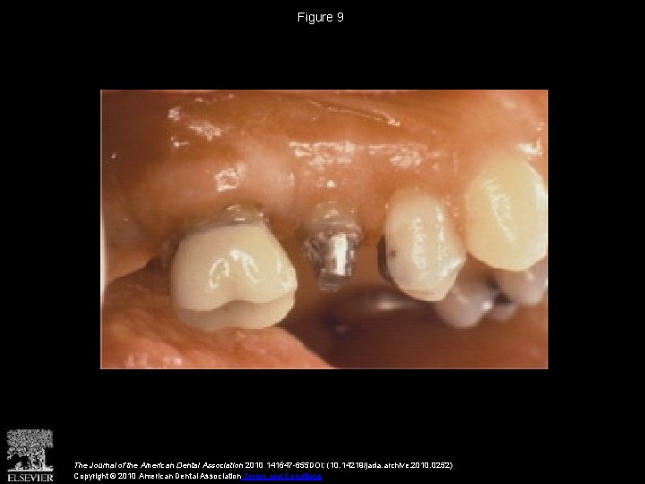 Figure 9 The Journal of the American Dental Association 2010 141647 -655 DOI: (10. Figure 9 The Journal of the American Dental Association 2010 141647 -655 DOI: (10.
