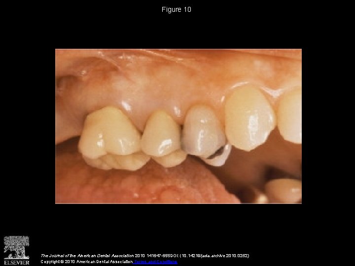 Figure 10 The Journal of the American Dental Association 2010 141647 -655 DOI: (10. Figure 10 The Journal of the American Dental Association 2010 141647 -655 DOI: (10.