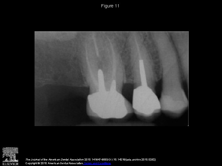 Figure 11 The Journal of the American Dental Association 2010 141647 -655 DOI: (10. Figure 11 The Journal of the American Dental Association 2010 141647 -655 DOI: (10.