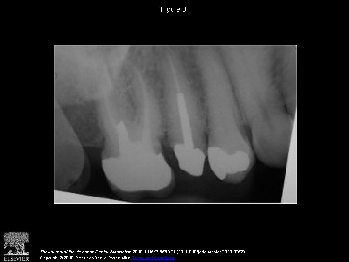 Figure 3 The Journal of the American Dental Association 2010 141647 -655 DOI: (10. Figure 3 The Journal of the American Dental Association 2010 141647 -655 DOI: (10.