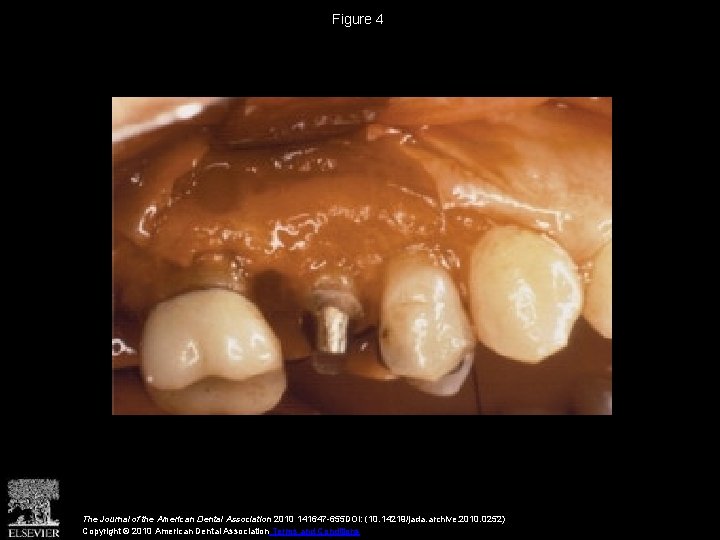 Figure 4 The Journal of the American Dental Association 2010 141647 -655 DOI: (10. Figure 4 The Journal of the American Dental Association 2010 141647 -655 DOI: (10.