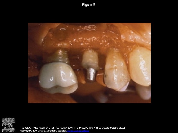Figure 5 The Journal of the American Dental Association 2010 141647 -655 DOI: (10. Figure 5 The Journal of the American Dental Association 2010 141647 -655 DOI: (10.
