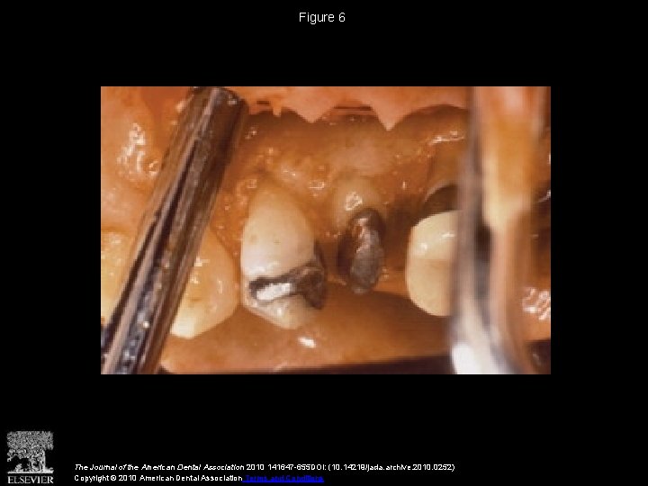 Figure 6 The Journal of the American Dental Association 2010 141647 -655 DOI: (10. Figure 6 The Journal of the American Dental Association 2010 141647 -655 DOI: (10.