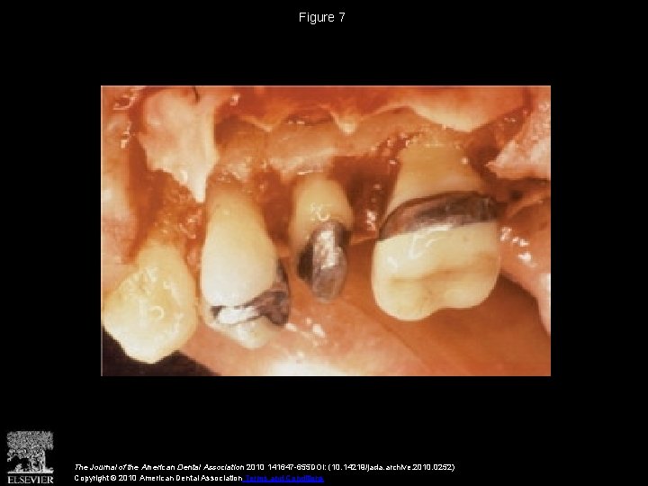 Figure 7 The Journal of the American Dental Association 2010 141647 -655 DOI: (10. Figure 7 The Journal of the American Dental Association 2010 141647 -655 DOI: (10.