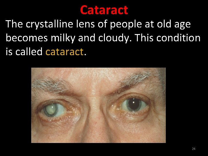 Cataract The crystalline lens of people at old age becomes milky and cloudy. This