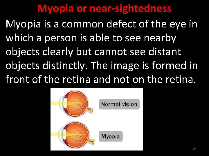 Myopia or near-sightedness Myopia is a common defect of the eye in which a