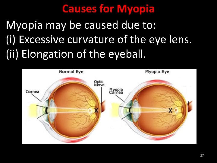 Causes for Myopia may be caused due to: (i) Excessive curvature of the eye