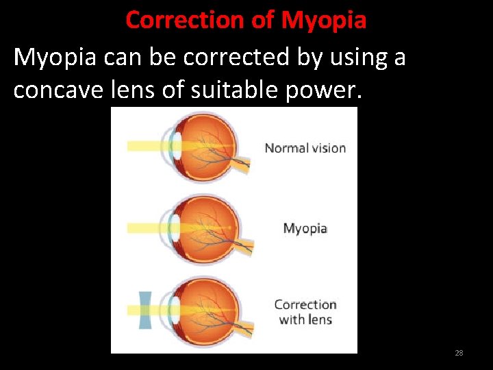 Correction of Myopia can be corrected by using a concave lens of suitable power.