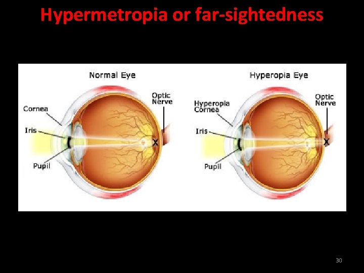 Hypermetropia or far-sightedness 30 