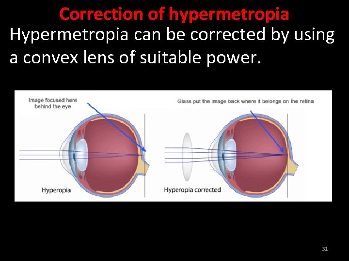 Correction of hypermetropia Hypermetropia can be corrected by using a convex lens of suitable