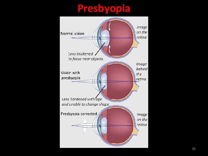 Presbyopia 33 