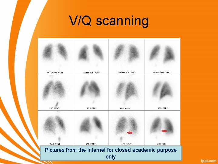 V/Q scanning Pictures from the internet for closed academic purpose only 