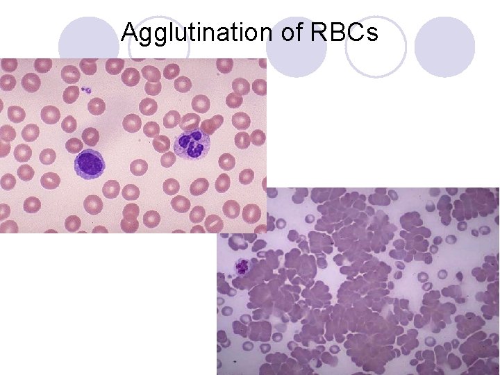 Agglutination of RBCs 