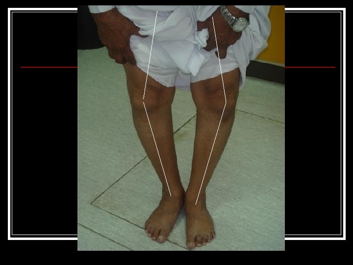 Knee Examination Abdulaziz AlAhaideb MD FRCSC Orthopedic physical