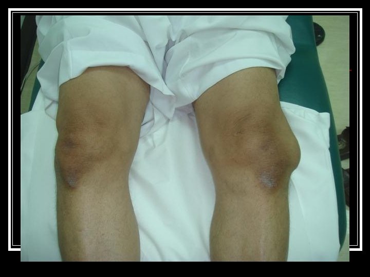 Knee Examination Abdulaziz AlAhaideb MD FRCSC Orthopedic physical