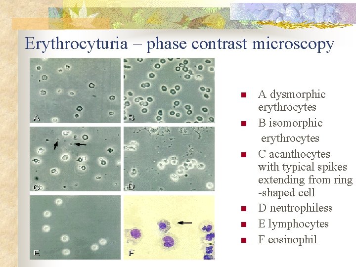 Erythrocyturia – phase contrast microscopy n n n A dysmorphic erythrocytes B isomorphic erythrocytes