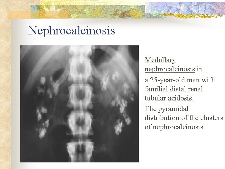 Nephrocalcinosis Medullary nephrocalcinosis in a 25 -year-old man with familial distal renal tubular acidosis.