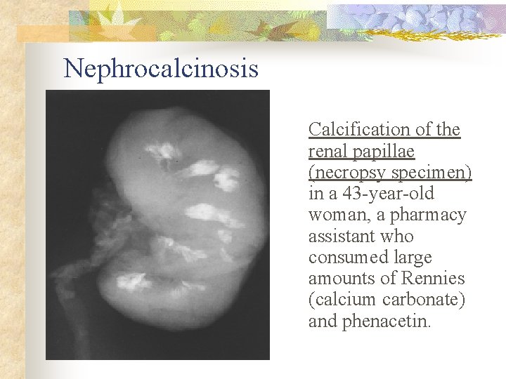 Nephrocalcinosis Calcification of the renal papillae (necropsy specimen) in a 43 -year-old woman, a
