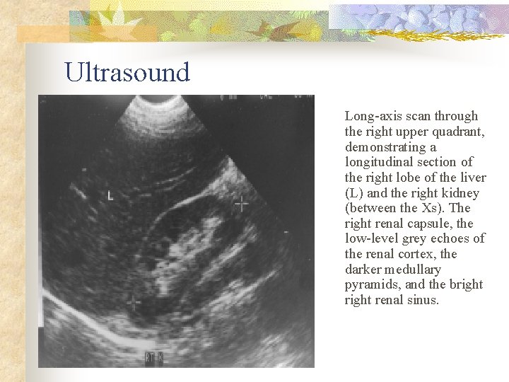 Ultrasound Long-axis scan through the right upper quadrant, demonstrating a longitudinal section of the