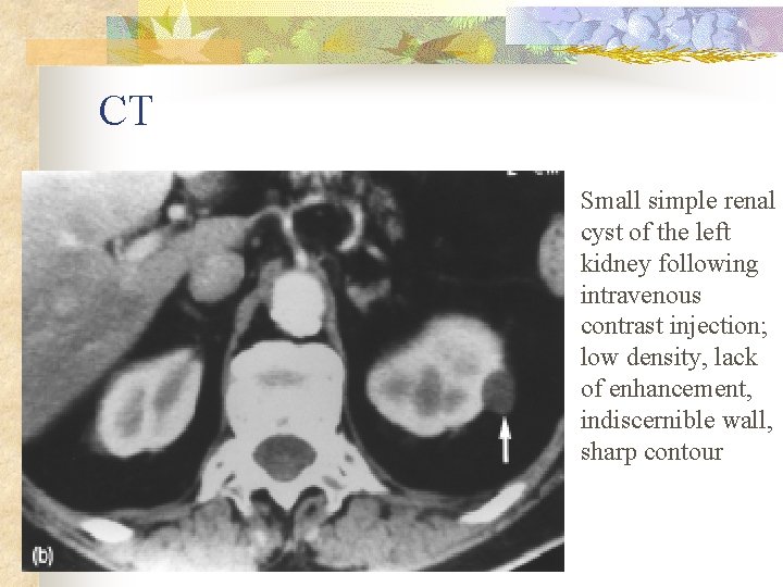 CT Small simple renal cyst of the left kidney following intravenous contrast injection; low