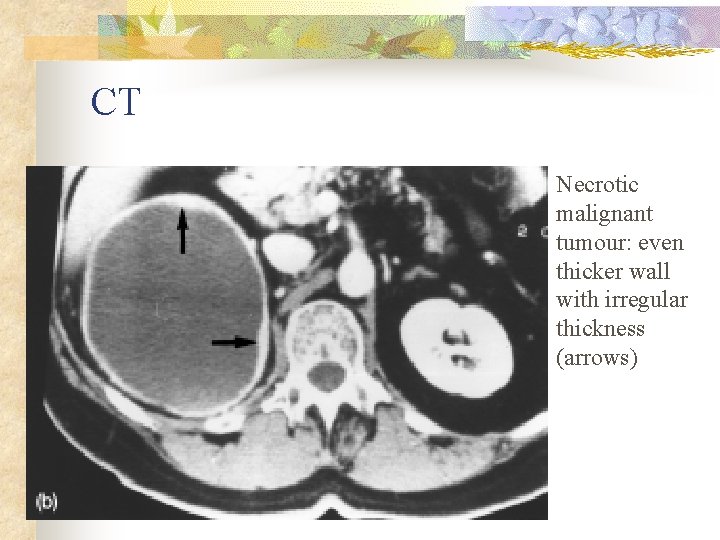 CT Necrotic malignant tumour: even thicker wall with irregular thickness (arrows) 