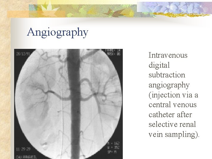 Angiography Intravenous digital subtraction angiography (injection via a central venous catheter after selective renal
