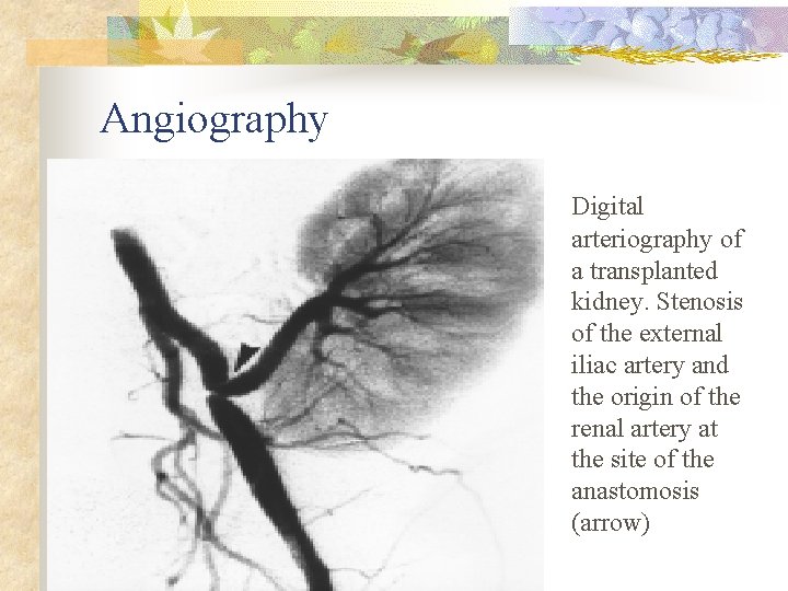 Angiography Digital arteriography of a transplanted kidney. Stenosis of the external iliac artery and