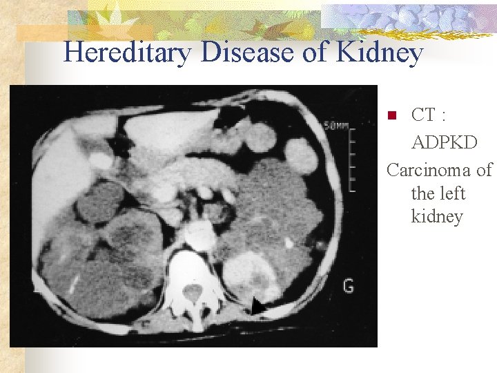 Hereditary Disease of Kidney CT : ADPKD Carcinoma of the left kidney n 