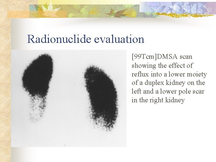 Radionuclide evaluation [99 Tcm]DMSA scan showing the effect of reflux into a lower moiety