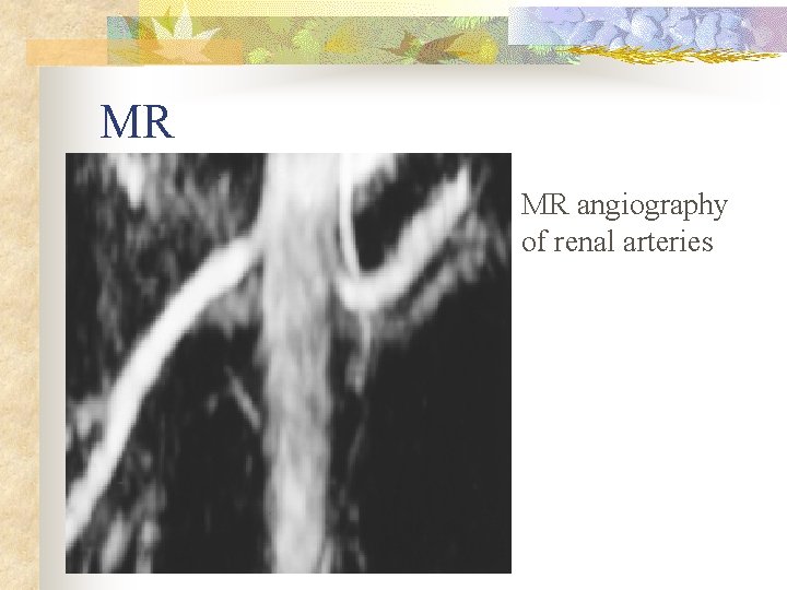 MR MR angiography of renal arteries 